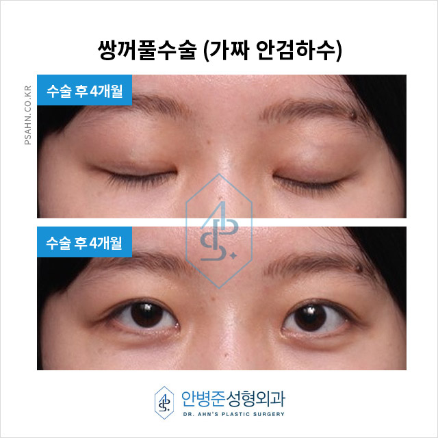 [가짜안검하수] 자연스러운 눈매를 위한 쌍꺼풀 수술과 피부 처짐 개선 효과 관련 이미지 2
