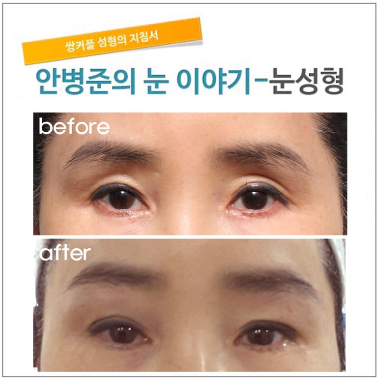 효과 좋은 지방이식 방법 관련 이미지 1