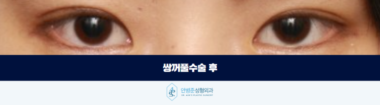 쌍꺼풀수술 자연스러운 눈을 만들기 위한 중요한 기준 관련 이미지 3