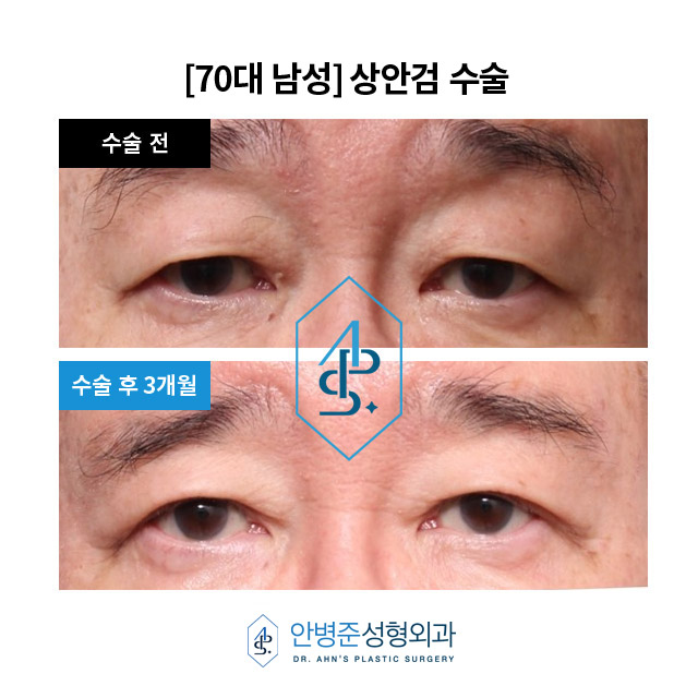 100세 시대, 50~70세에도 성형, 걱정하지 마세요! 관련 이미지 1