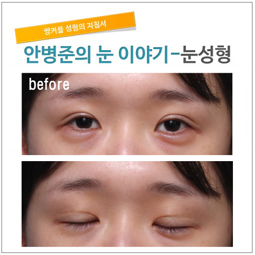 4년전 잘못된 절개법 수술후. 관련 이미지 1