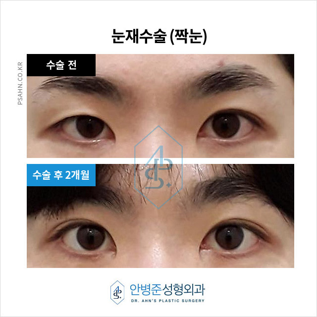 수술 후 짝짝이 눈 교정, 오른쪽 눈 라인 맞추기 사례! 관련 이미지 1