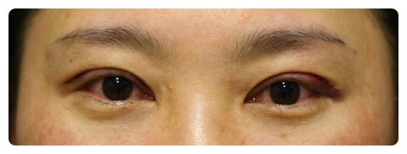 -소시지눈 고치기 과정-        [안병준의 눈이야기] 관련 이미지 8