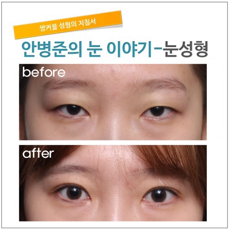 처진 피부가 삼백안 유발.(피부절제,지방제거,쌍꺼풀 절개법) 관련 이미지 1