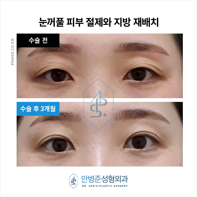 눈꺼풀 처짐 개선을 위한 수술, 어떤 방법이 있을까? 관련 이미지 2