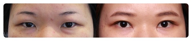 안병준의 쌍꺼풀 지침서4_쌍꺼풀수술 왜 하는가? 관련 이미지 2