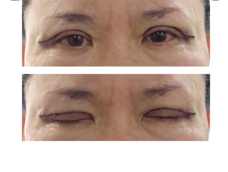 상안검성형술 관련 이미지 2