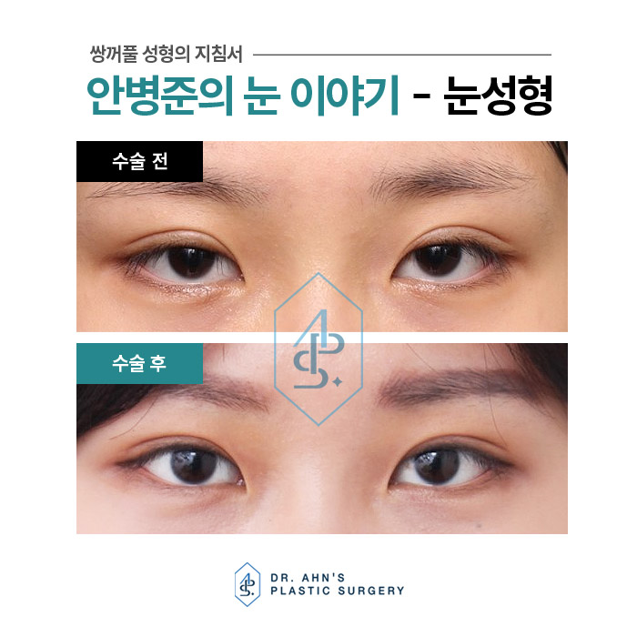 [방배역 성형외과] 꺼진 윗눈꺼풀 - 쌍꺼풀 수술 설명 관련 이미지 2