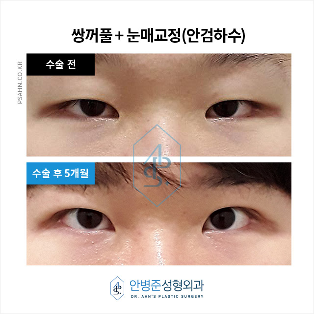 졸린 눈 고민, 이상적인 눈매 디자인과 수술 방법 관련 이미지 3