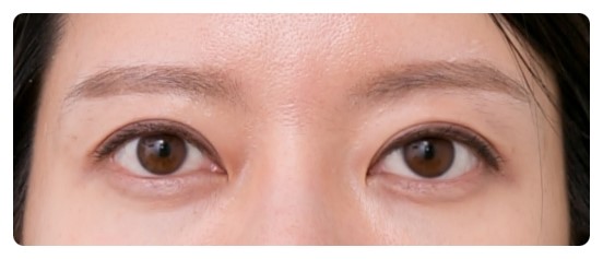 삼백안이란? 원인과 교정 관련 이미지 5