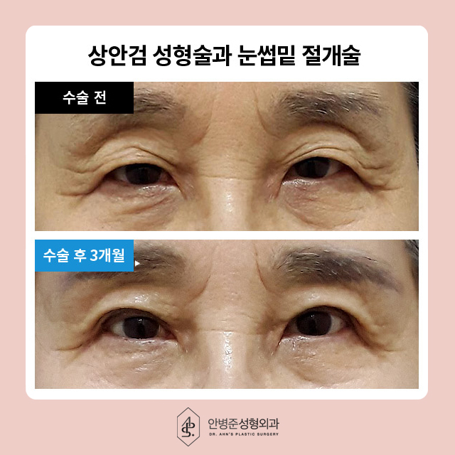 [이벤트] 상안검,하안검,눈썹거상 눈밑 지방재배치 관련 이미지 3