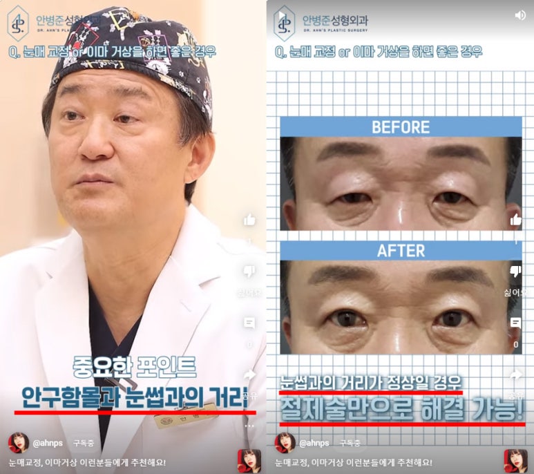 눈꺼풀 처짐의 포인트 - 안구함몰과 눈쌉과의 거리 관련 이미지 1