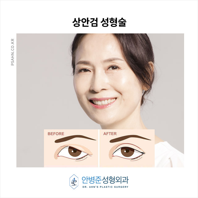 눈매가 달라진다! 상안검성형술로 자신감 되찾기 관련 이미지 1