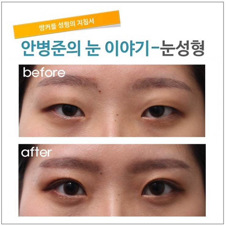 쌍꺼풀수술과 몽고주름 제거(윗트임)-절개법,윗트임,피부절제 관련 이미지 1
