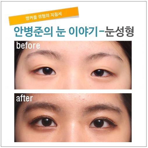 쌍꺼풀과 윗트임개념의 앞트임 수술 관련 이미지 1