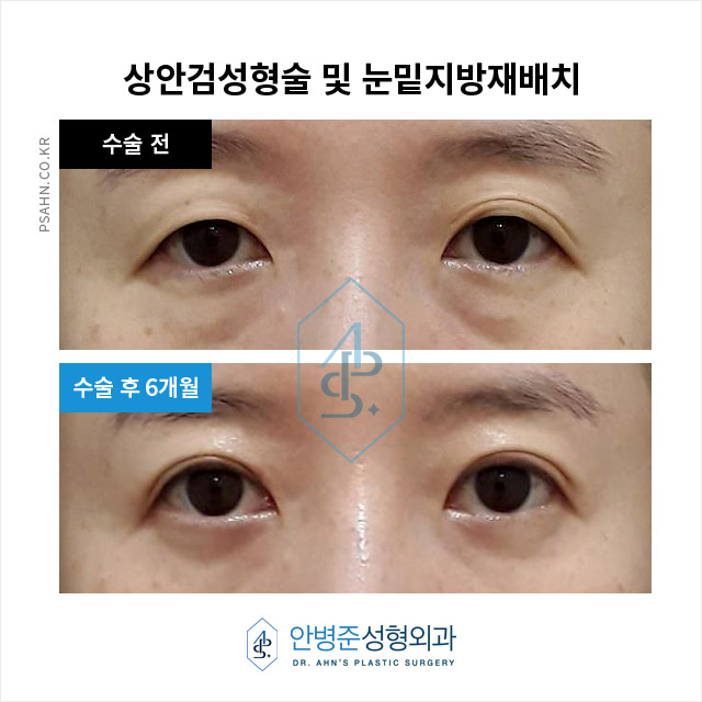 [강남성형외과]상안검성형술 및 눈밑지방재배치 사례 관련 이미지 1