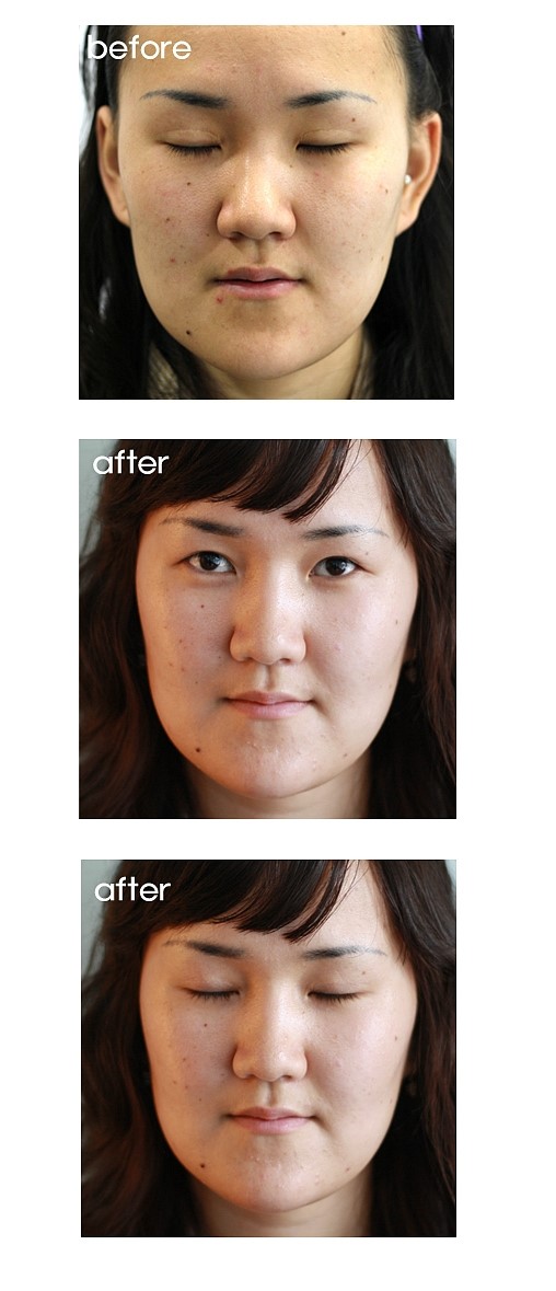 심한 소시지눈 고치기(재수술,소시지눈재수술,쌍꺼풀재수술) 관련 이미지 2