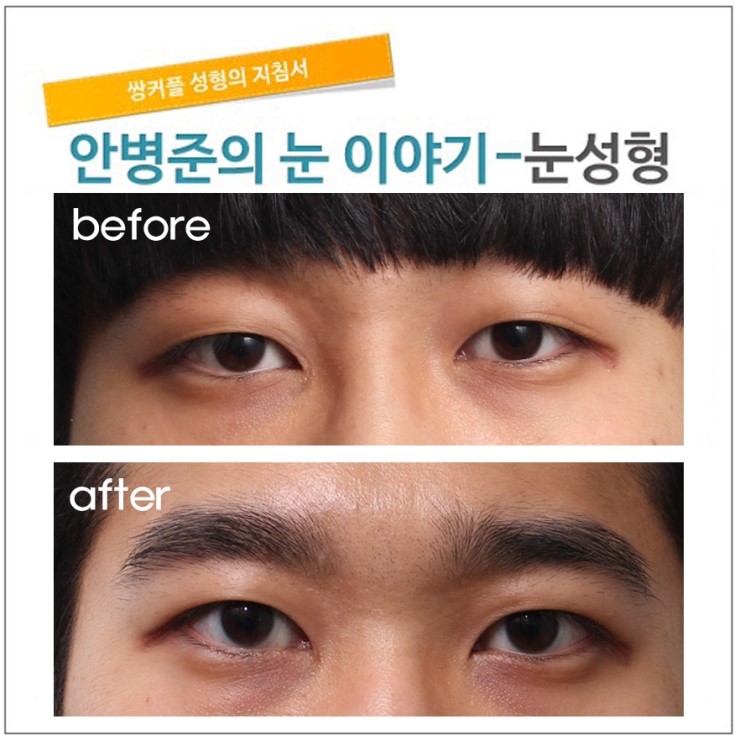 완전 속쌍꺼풀. 관련 이미지 1