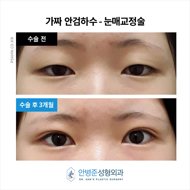 [강남성형외과] 가짜 안검하수의 눈매교정술 사례 관련 이미지 1