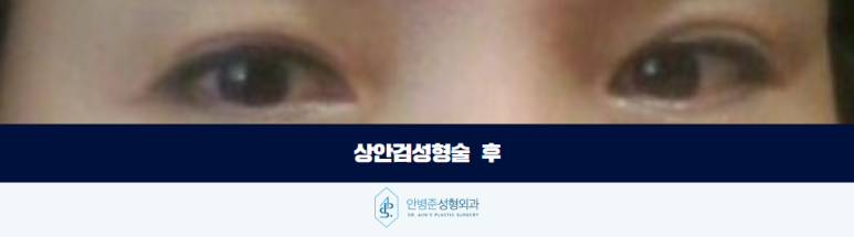 상안검성형술 처진 눈꺼풀로 고민이라면 확인해야 할 것 관련 이미지 3