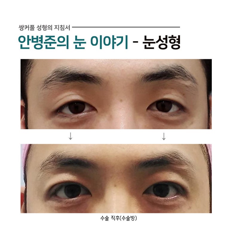 쌍꺼풀,눈매교정(쌍수,안검하수) 관련 이미지 1