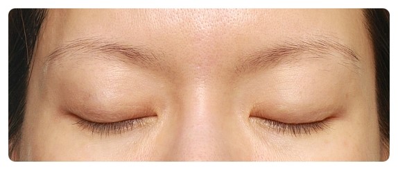 삼백안 교정 원인을 먼저 세심하게 봐야 합니다 관련 이미지 4