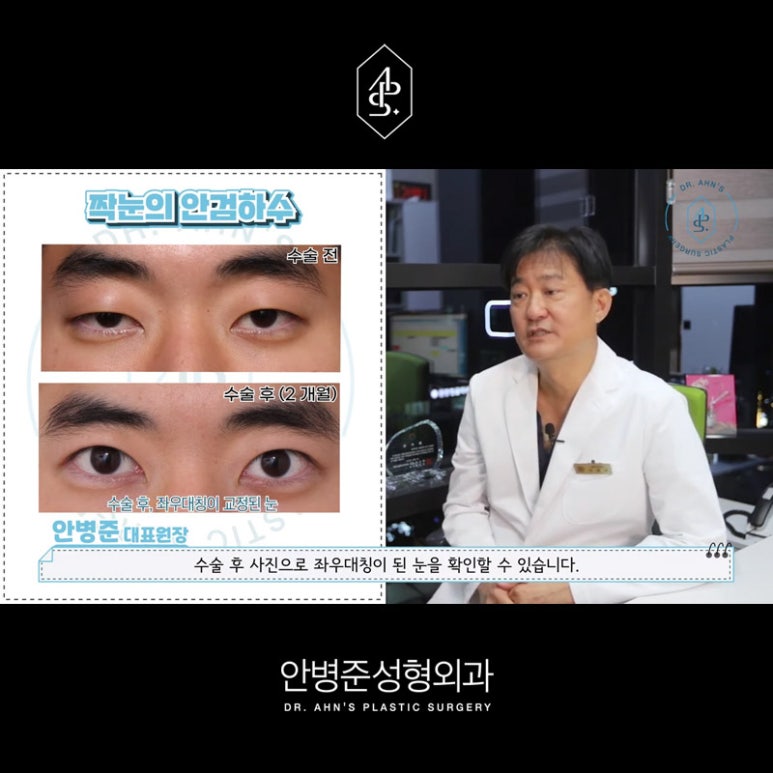 [남자성형외과] 남자 눈성형 쌍꺼풀수술 사례 모음 관련 이미지 4