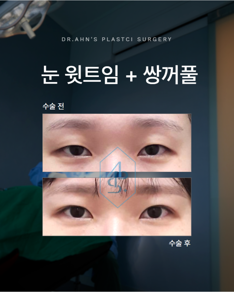 Upper Canthoplasty and Double Eyelid Surgery: If You Do Not Have Ptosis, Ptosis Correction Is Unnecessary image 1