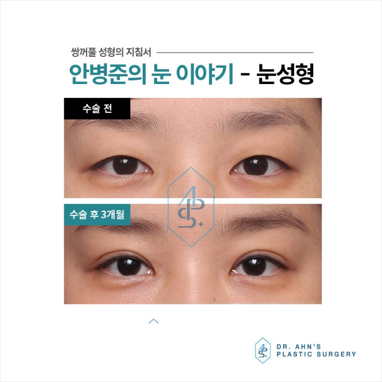 [눈성형] 쌍꺼풀수술을 선택하는 3가지 이유는?? 관련 이미지 1