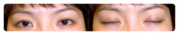 쌍꺼풀 라인 고정 자연스러움을 이끌어내는 기준 관련 이미지 3