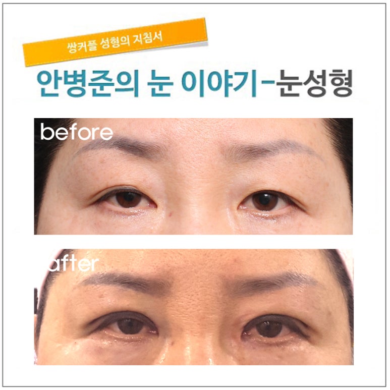 쌍꺼풀 라인의 크기(쌀꺼풀라인줄이기,라인높이기) 관련 이미지 1