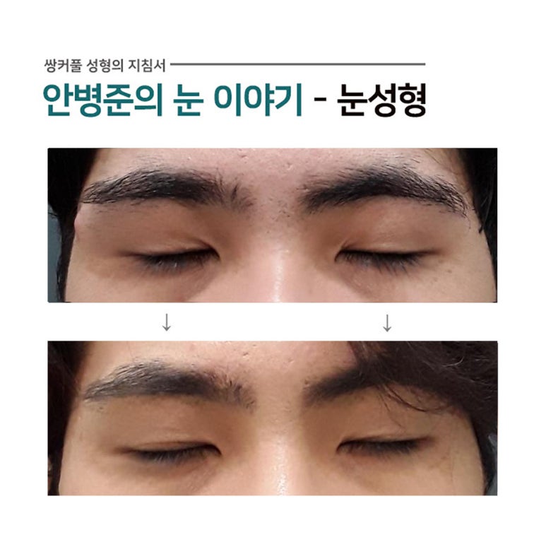 안검하수와 처진 피부가 공존하는 전형적인 남자 눈(눈매교정,피부절제) 관련 이미지 2
