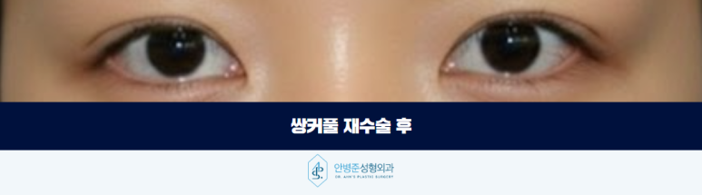 쌍꺼풀 라인크기 두껍게 한다고 정답은 아닙니다 관련 이미지 3