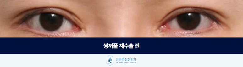 쌍꺼풀 재수술 잘하는병원 여러 번 수술한 눈일수록 이것이 필요합니다 관련 이미지 2