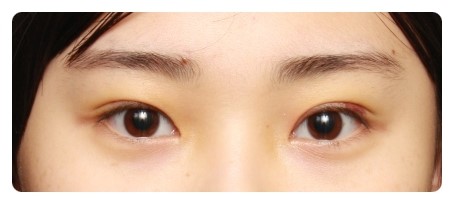 수술후 1개월 경과후&눈감은 모습             [안병준의 눈이야기] 관련 이미지 2