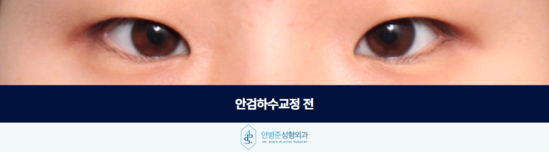 Before Correcting Ptosis, You Must First Determine Whether Skin Sagging Is the Cause image 2