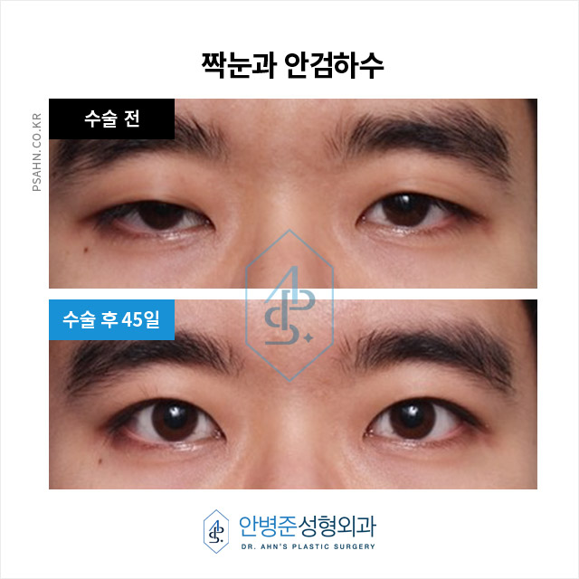 [짝눈성형] 거울을 볼 때마다 두 눈이 달라 보여요 ㅠ 관련 이미지 2