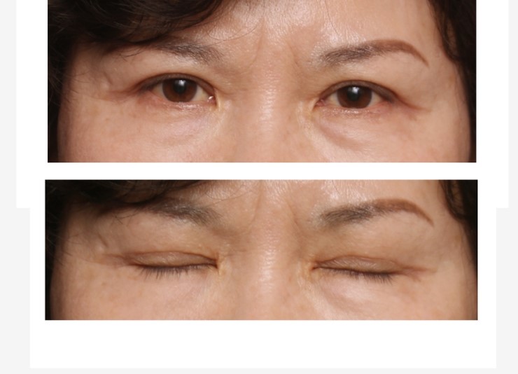 상안검성형술 관련 이미지 4