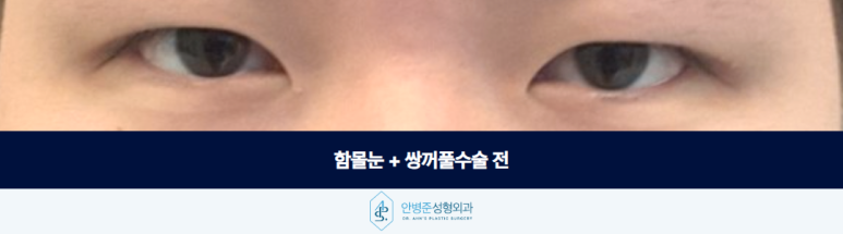 함몰눈 쌍꺼풀수술 꼼꼼한 분석으로 자연스러운 설계 및 개선까지 관련 이미지 2