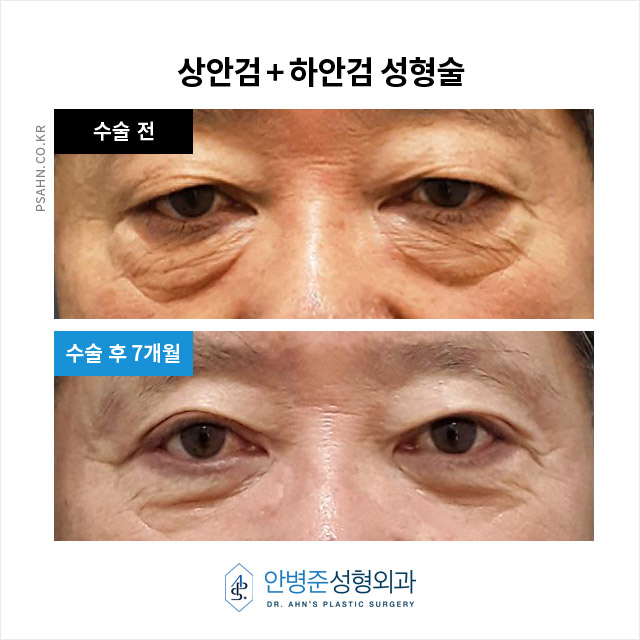 [상안검,하안검]100세 시대, 남성 상하안검성형술의 새로운 관심 관련 이미지 2