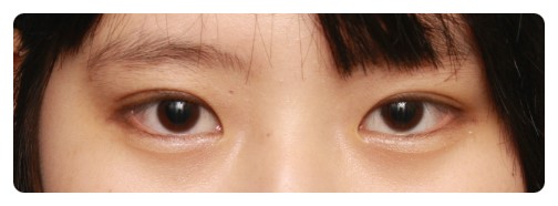 -자연스런 쌍꺼풀이 뭘까??-          [안병준의 눈이야기] 관련 이미지 5