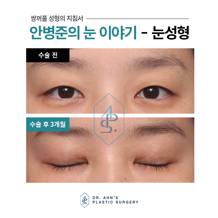 [자연스러운 쌍꺼풀] 4일째 실밥제거 / 3개월 후 사진 관련 이미지 8