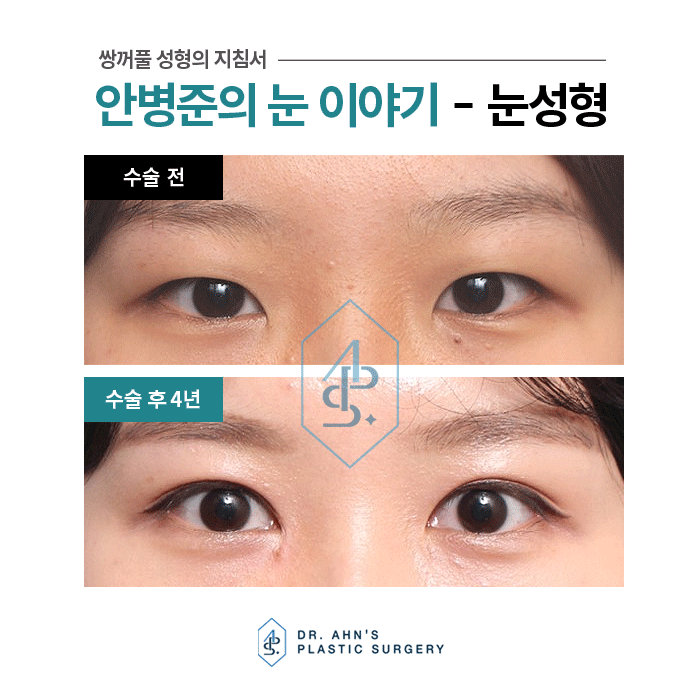 눈꺼풀과 눈두덩이가 두껍다? 피부저침? 절개법! 관련 이미지 3