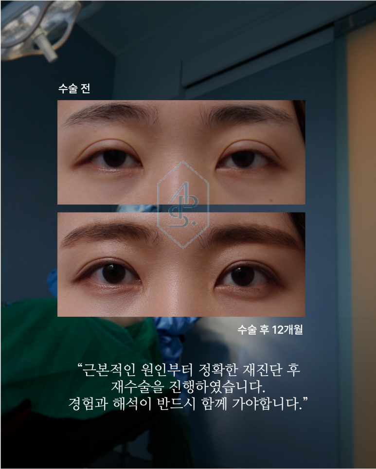 쌍꺼풀재수술 잃어버렸던 자연스러운 눈을 찾아서 관련 이미지 1