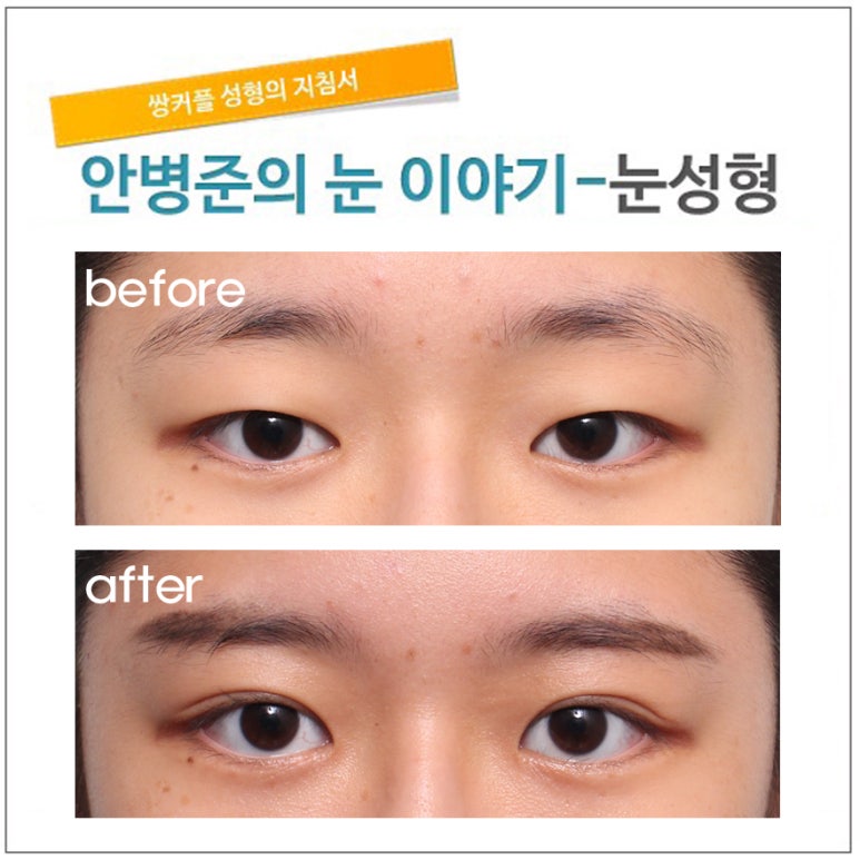 동양인 눈(자연 쌍꺼풀,자연스러운쌍꺼풀수술) 관련 이미지 1