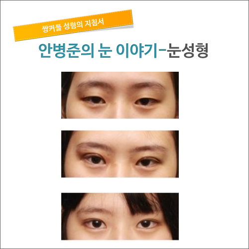 쌍커풀수술직후&수술후 1개월 _안병준의 눈이야기 관련 이미지 1