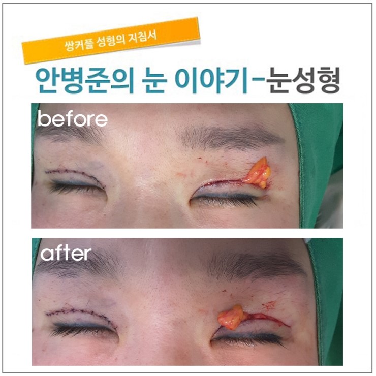 지방감소 눈꺼풀.(꺼진눈,꺼진눈수술,상안검성형,지방재배치) 관련 이미지 2