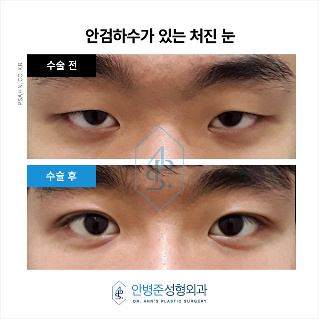 남성 쌍꺼풀 - 자연스러운 이미지 개선과 기능 회복 관련 이미지 4