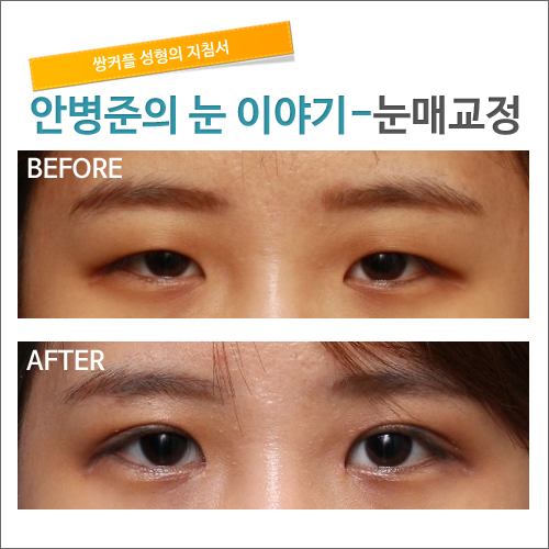 안검하수 눈매교정 눈성형잘하는병원 시크릿성형외과_안병준 관련 이미지 1