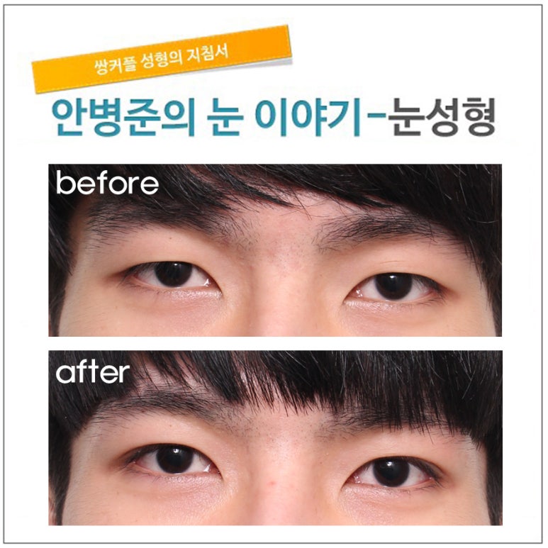 약간의 몽고주름 제거와 쌍수 관련 이미지 1